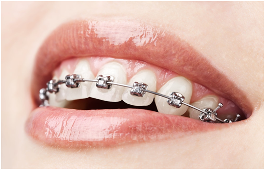Dental Braces: How Does Treatment Work and What Does it Cost?